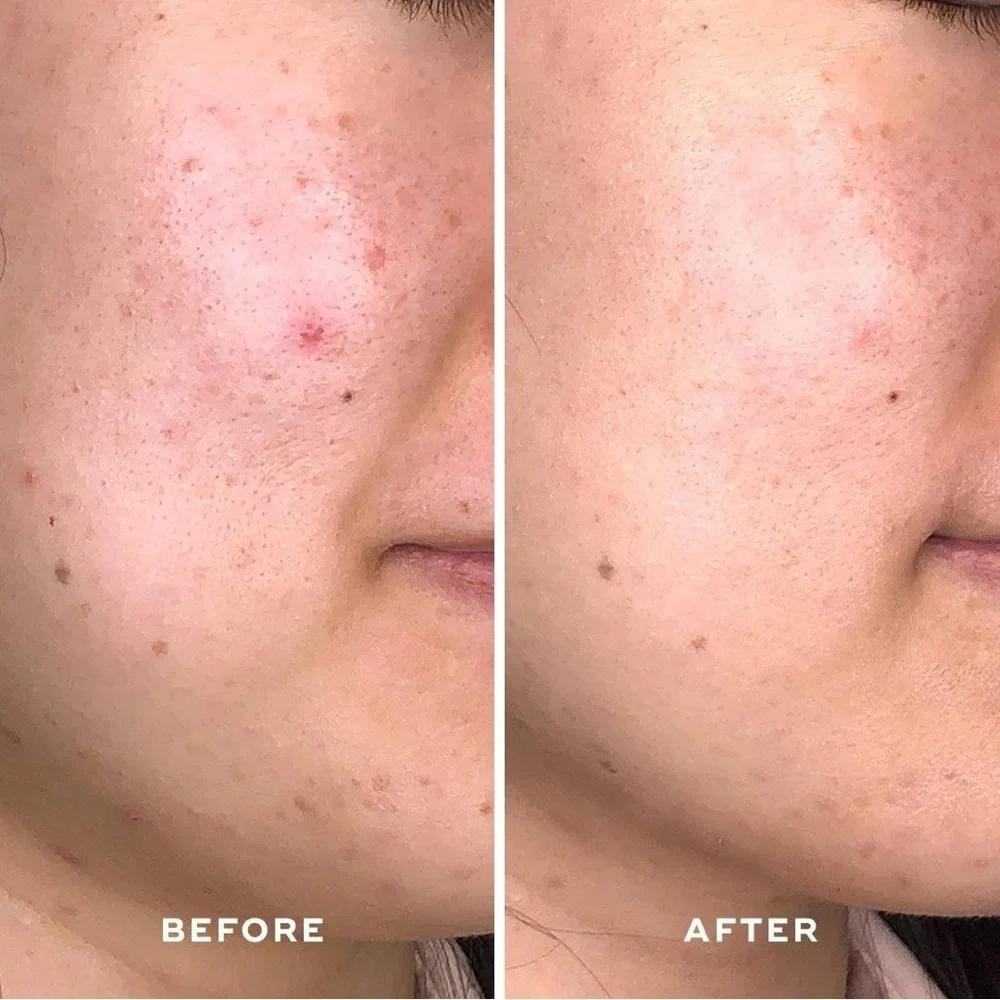 Aceology Detoxifying Treatment Mask - Picture 6 of 11
